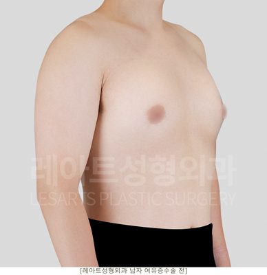 여성형유방증 수술 전 사진