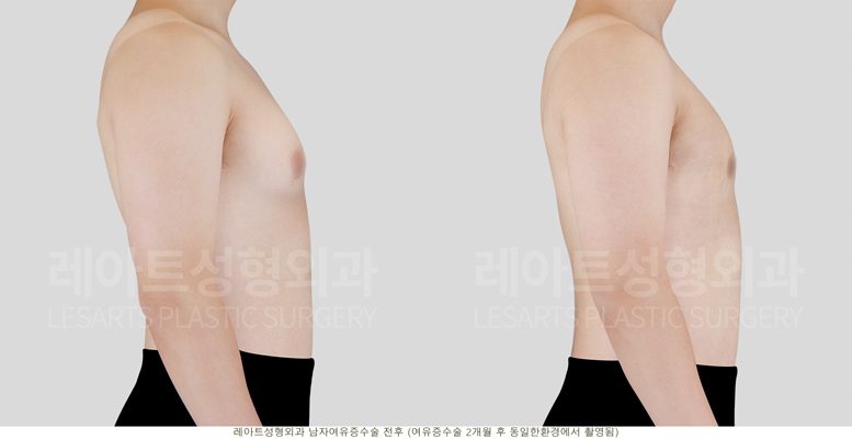 여성형유방증 - 전후 비교 옆모습
