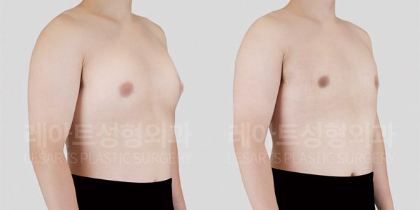 여성형유방증 전후사진