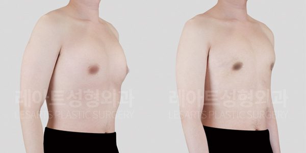 여유증 그레이드2-a수술 전후 사진