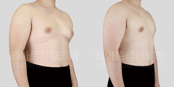 여유증 수술 전후 그레이드 2-b