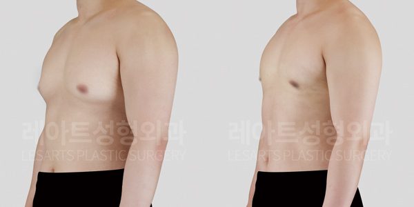 여쥬증 가슴 비대칭 교정 사례 전후 사진
