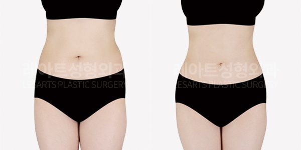 복부지방흡입 , 팔 지방흡입 전후사진
