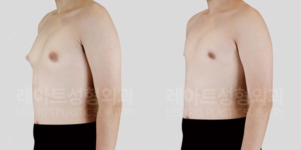 여유증 수술 후 전후 비교사진