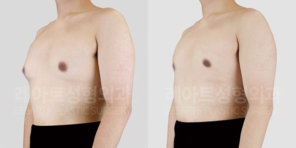 남자 여유증 수술 전후 그레이드 2-A