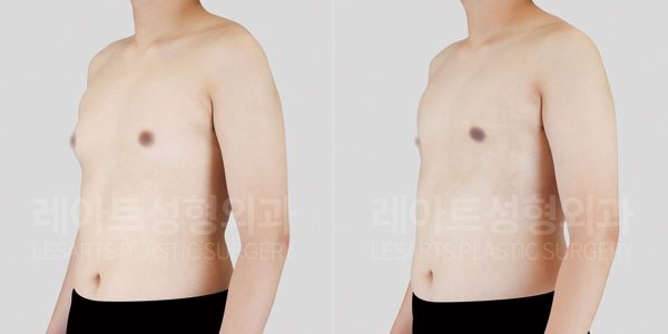 여유증 수술 전후 그레이드 2-A