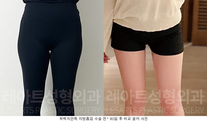 허벅지 지방흡입 후 셀카사진