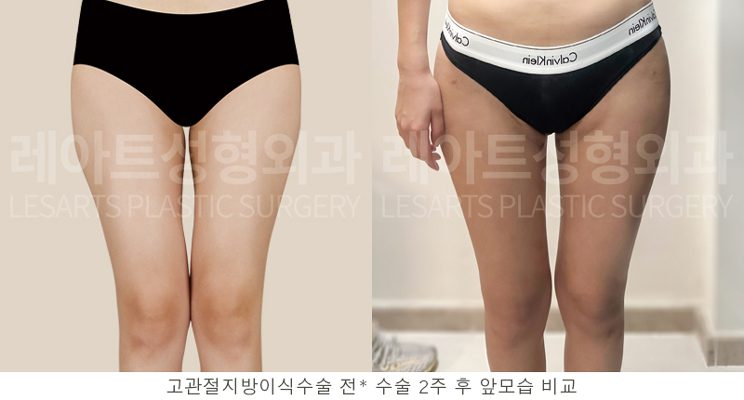 허벅지 지방흡입 전후 셀카 사진 - 정면