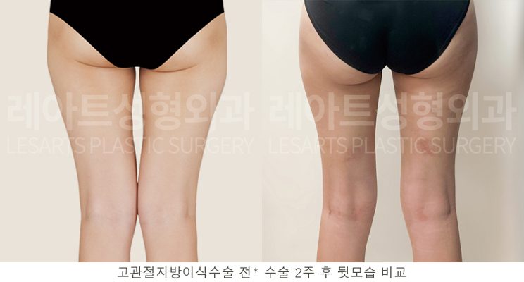 허벅지 지방흡입 전후 셀카 사진 - 후면