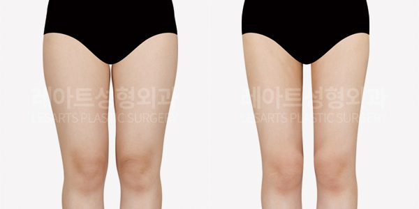 허벅지 지방흡입 수술 전후사진