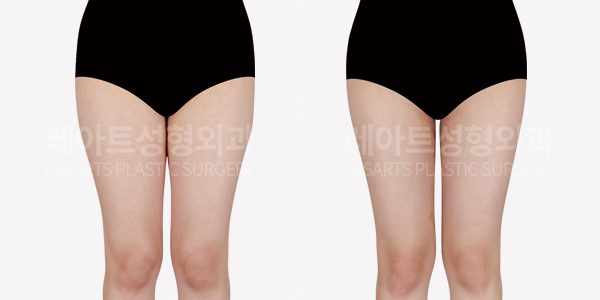 허벅지 지방흡입 전후 2주후