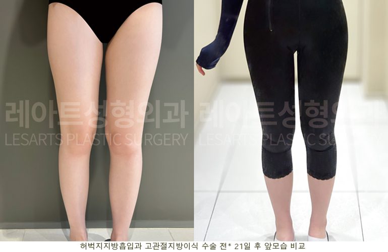 허벅지 지방흡입, 고관절 지방이식 전후 셀카 사진