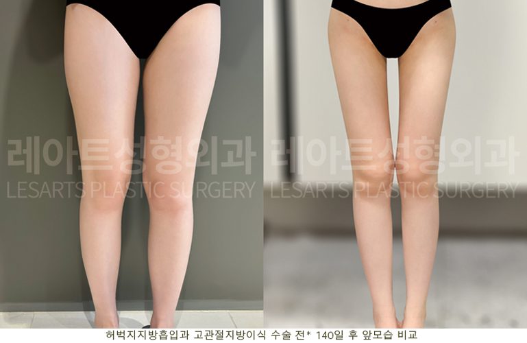 허벅지 지방흡입, 고관절 지방이식 전후 셀카 사진