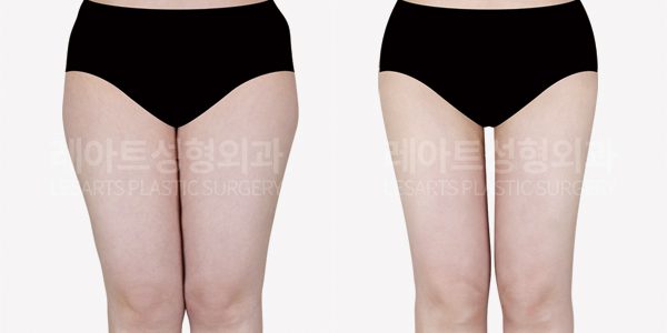 허벅지 지방흡입, 치구 지방흡입 전후