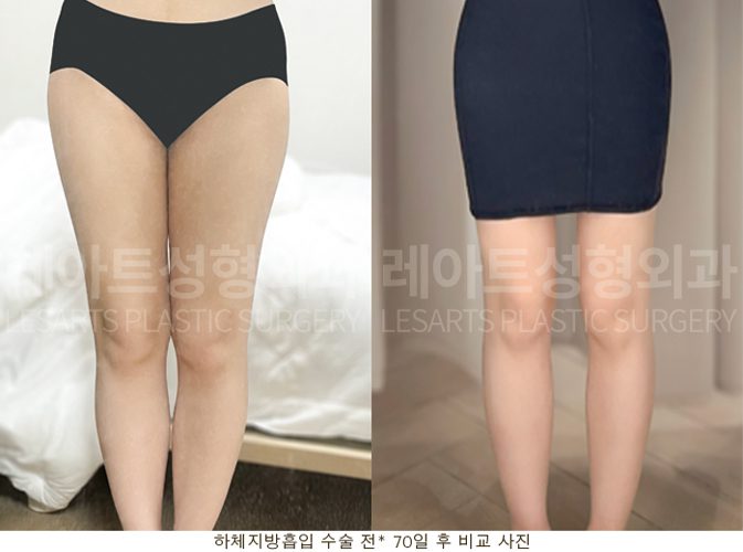 허벅지 종이라 지방흡입 전후 셀카사진