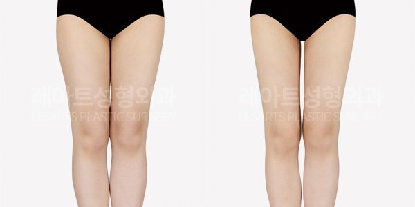 허벅지 종이라 지방흡입 전후사진