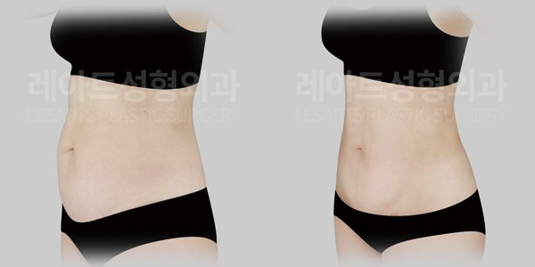 복부거상 전후 - 레아트 성형외과