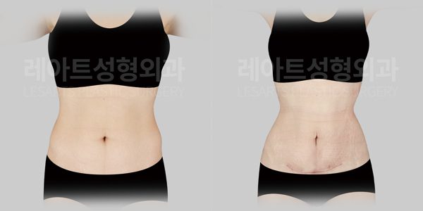 출산 후 복부거상 전후 비교 사진