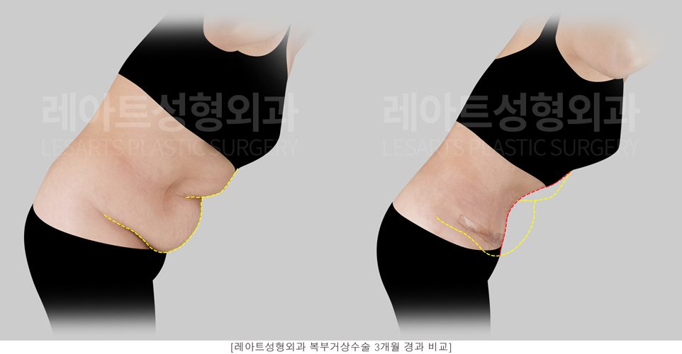 복부거상 전후 사진 옆모습