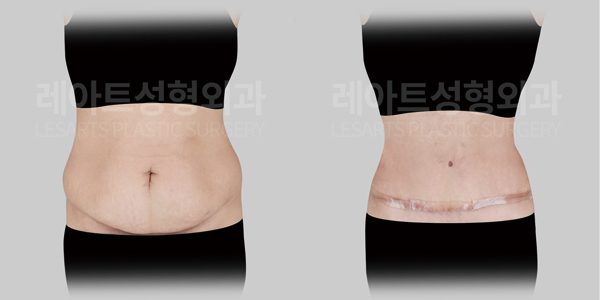 복부거상 전후 사진 정면