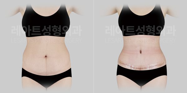 제왕절개 후 복부거상 전후사진 앞모습
