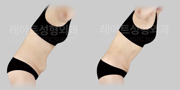 복부거상 전후 사진, 처진뱃살 교정, 처진 복부 보정