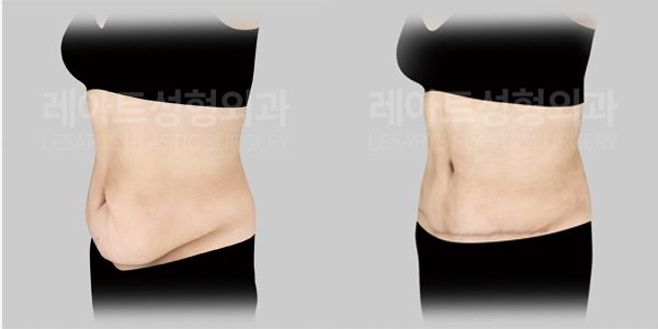 요요로 인한 복부거상 전후 사진 옆모습