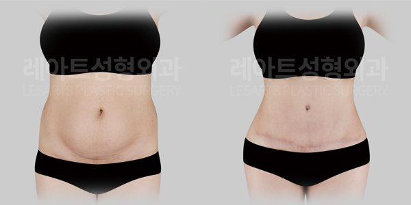 복부거상수술 전후 사진 , 복직근 이개 교정