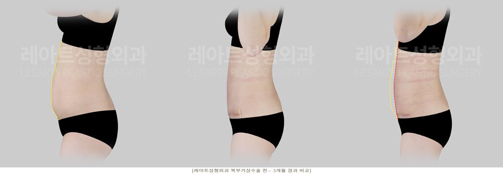 복부거상, 복부거상술 전후비교 사진