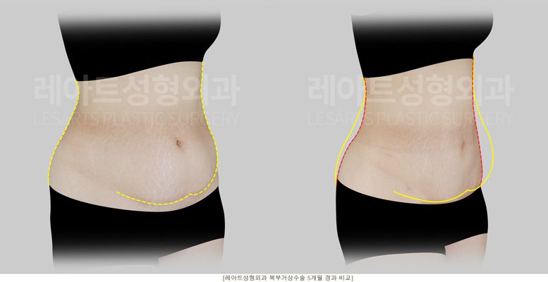 출산 후 복부거상 전후 사진