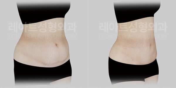 출살 후 복부거상 전후 사진 - 레아트 성형외과