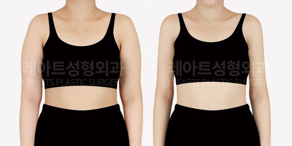 출산 후 팔 지방흡입 전후 사진 레아트 성형외과