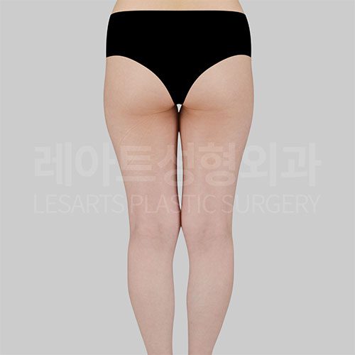 허벅지 지방흡입 뒷모습 포스트07