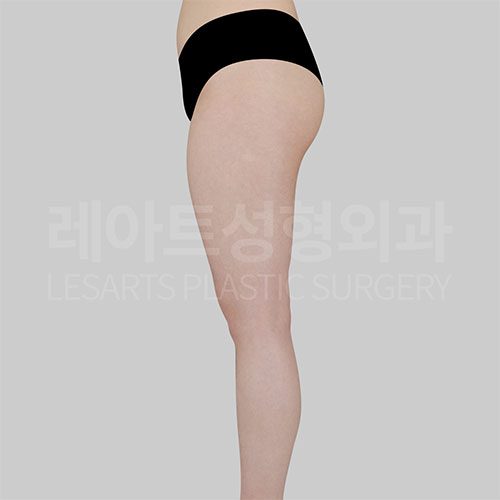 thigh_lipocucion_post07_06
