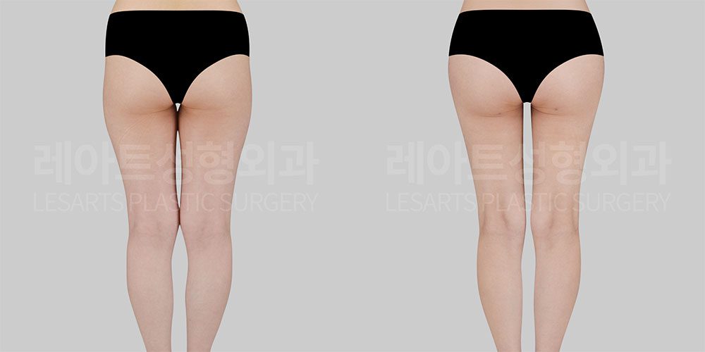 허벅지 지방흡입 전후 후면