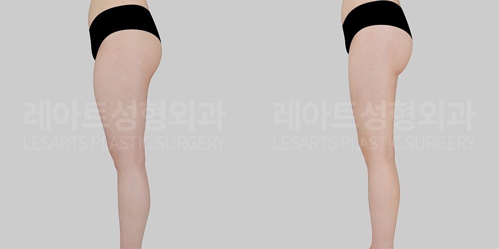 허벅지 지방흡입 전후 측면