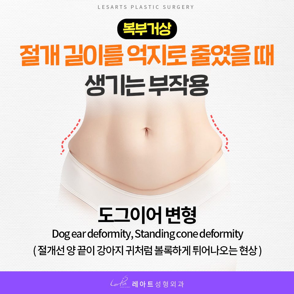 복부거상수술 흉터 고민