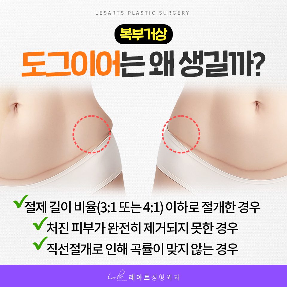 복부거상 도그이어