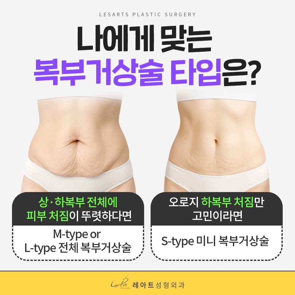 복부거상술 타임