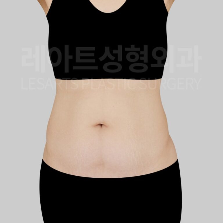 c-abdominal-liposuction-post09-01