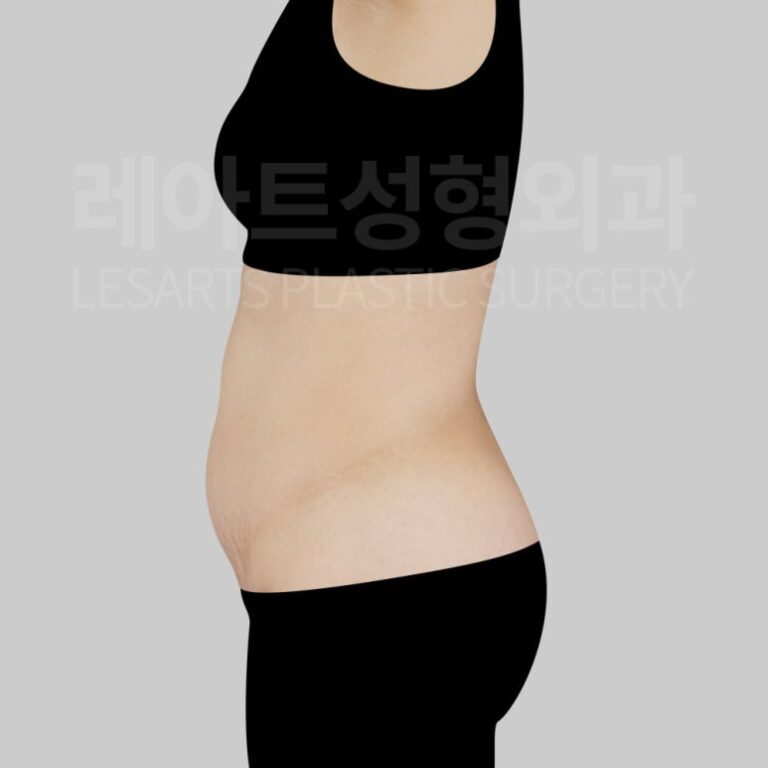 c-abdominal-liposuction-post09-02