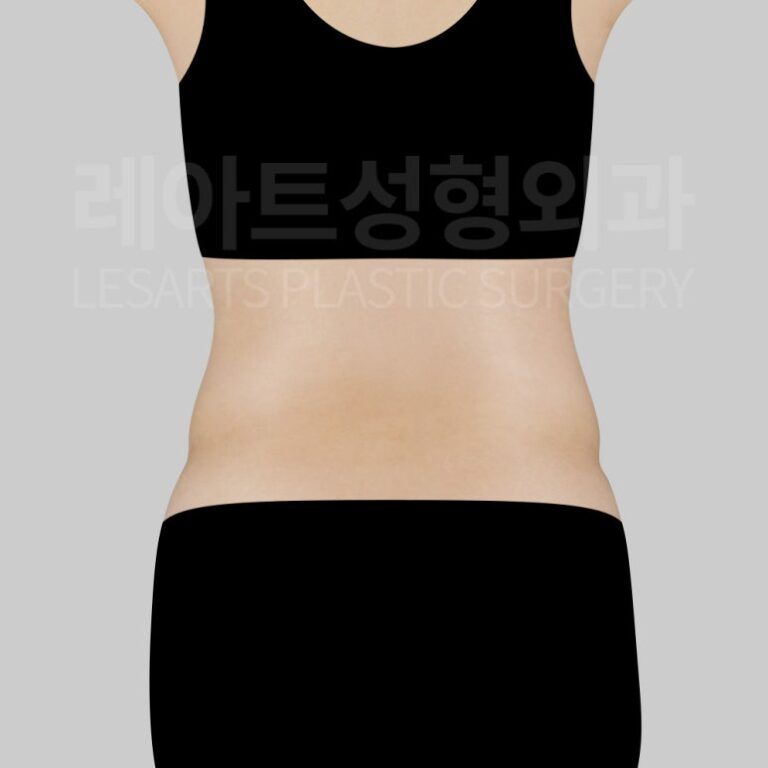 c-abdominal-liposuction-post09-03