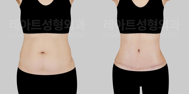 복부 지방흡입, 복부 거상 전후사진