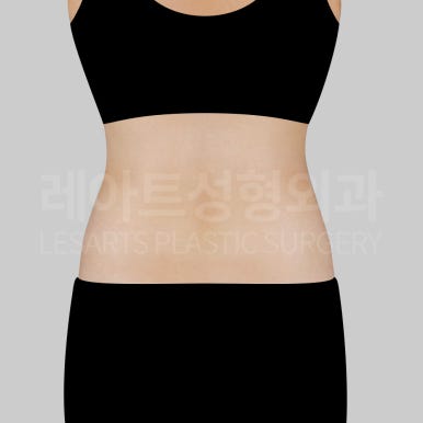 c-abdominal-liposuction-post10-03