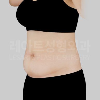 c-abdominal-liposuction-post10-05