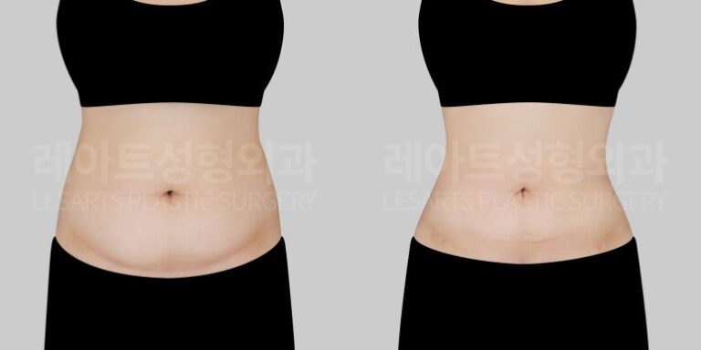 출산 후 복부 지방흡입 전후사진