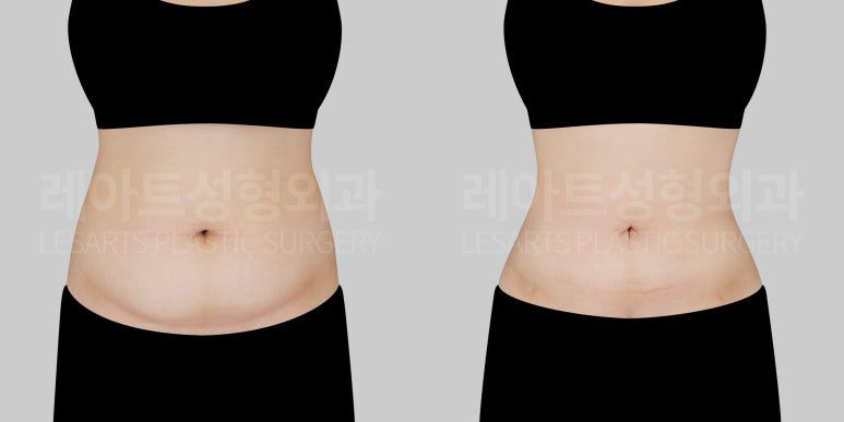 출산 후 복부 지방흡입 전후사진