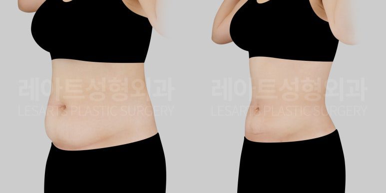 복부 지방흡입 전후사진 옆모습 - 레아트 성형외과