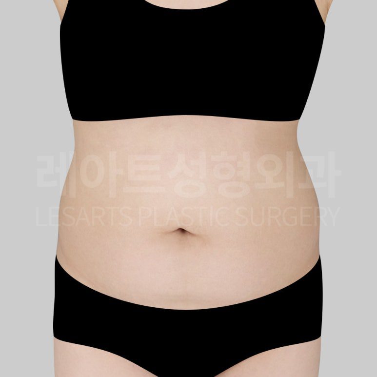 c-abdominal-liposuction-post13-01