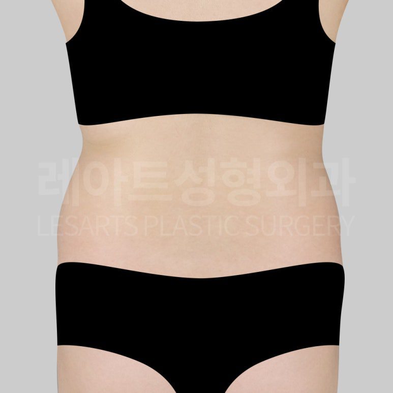 c-abdominal-liposuction-post13-02